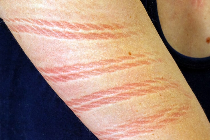 Ein Arm mit klar erkennbaren Seilabdrücken