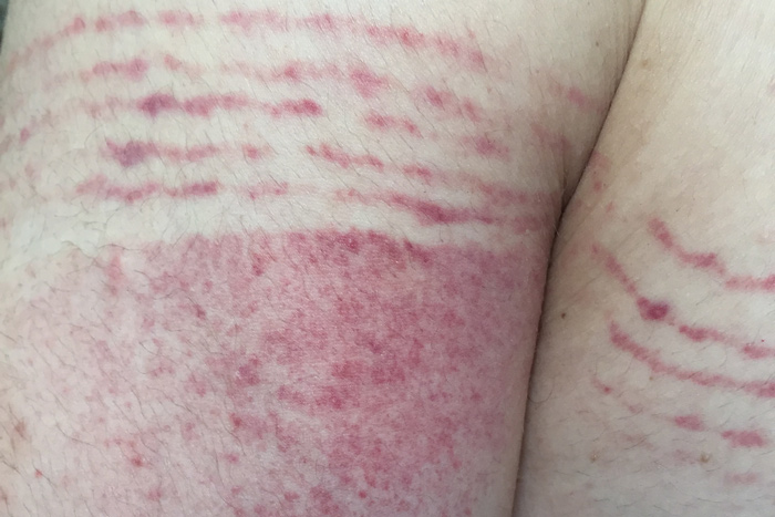 Bild von einem Hämatom